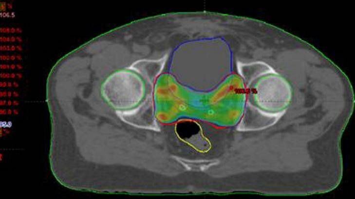 A CT scan of the prostate Photo: Supplied