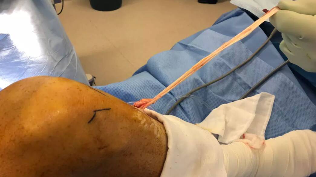 Dr Hartnell says human hamstring tendon (shown here in knee reconstruction surgery) is remarkably similar to a kangaroo's, although a roo tendon is as much as six times stronger. Photo: Supplied